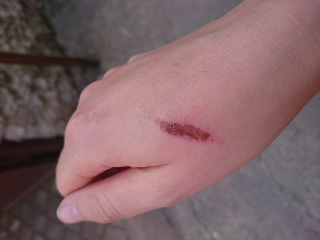 rana po oparzeniu skóry